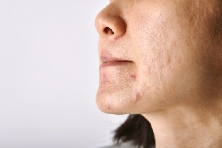 Skin problem with acne diseases