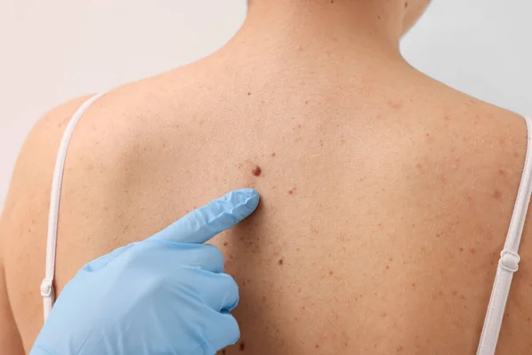 Read more about the article Mole Check