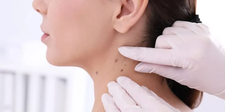 Services - Skin Cancer Screening