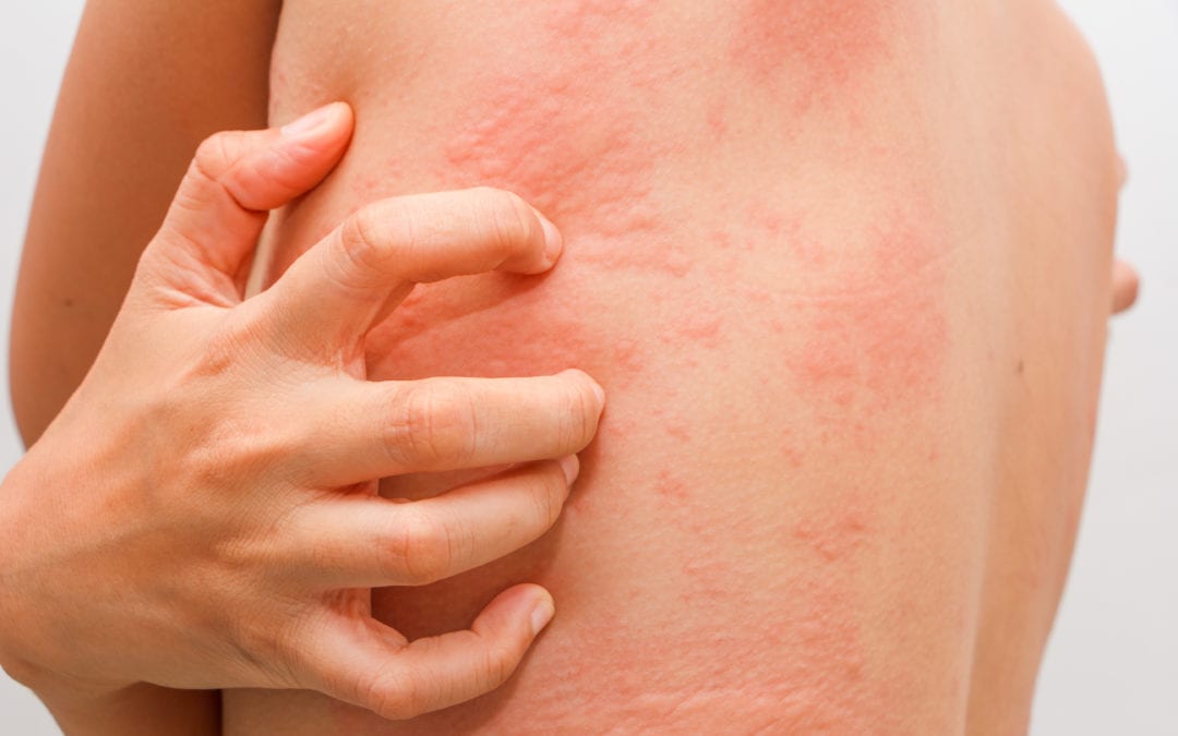 Read more about the article Contact Allergy