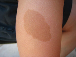 Services - Kids Laser Treatment