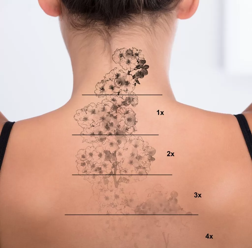 Read more about the article Tattoo Removal