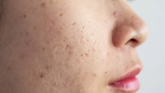 Acne, Pigmentation & Dull Skin