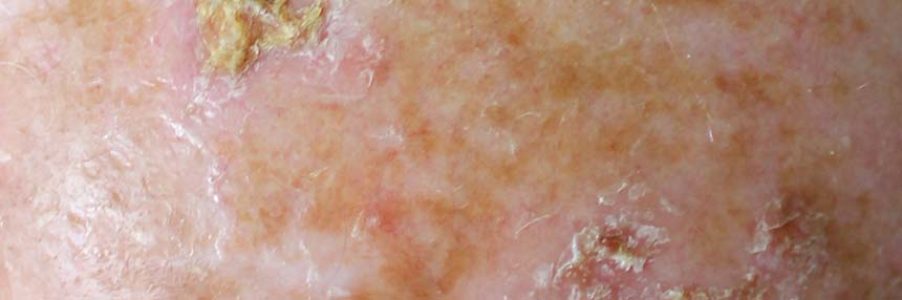 Hypertrophic lesions of actinic keratosis on sun-damaged skin.