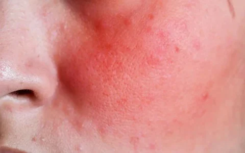 Facial Redness