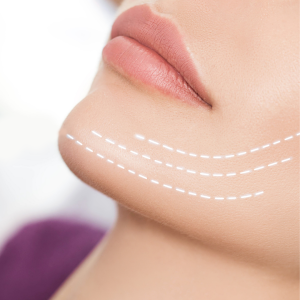 Facial Volume & Contouring