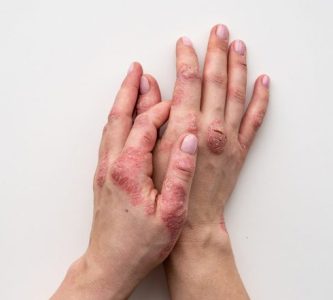 PSORIASIS