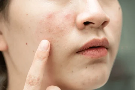 Scars & Skin Resurfacing