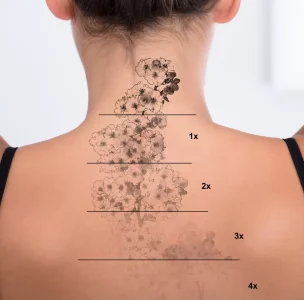 Services - Tattoo Removal