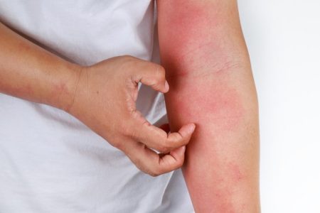 Skin Infection