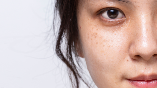 Skin Pigmentation