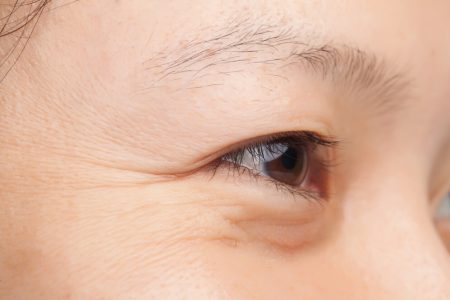 Wrinkles-Around-Your-Eyes