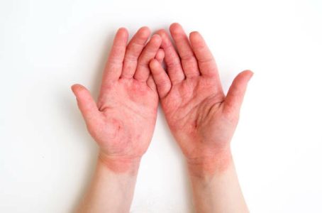 4 year old child red swollen cracked atopic dermatitis hands caused by lot of hand washing and hand sanitizing during covid-19 pandemic period in 2020.