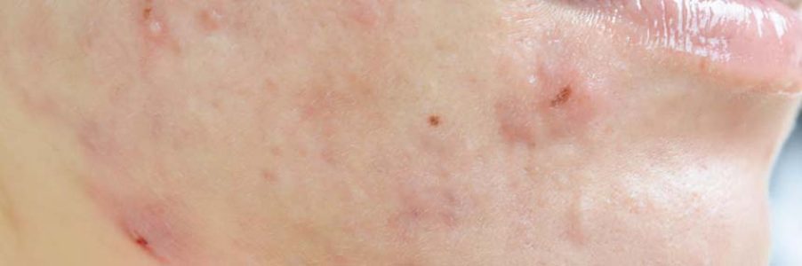 Scar from Acne on face