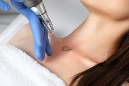 Picocare: The Most advanced painfree laser for permanent tattoo removal in  Delhi NCR – VLCC LUXE